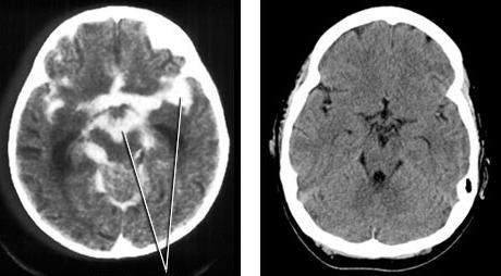 objawy odkleszczowego zapalenia mózgu